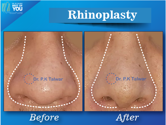 rhinoplasty surgery result